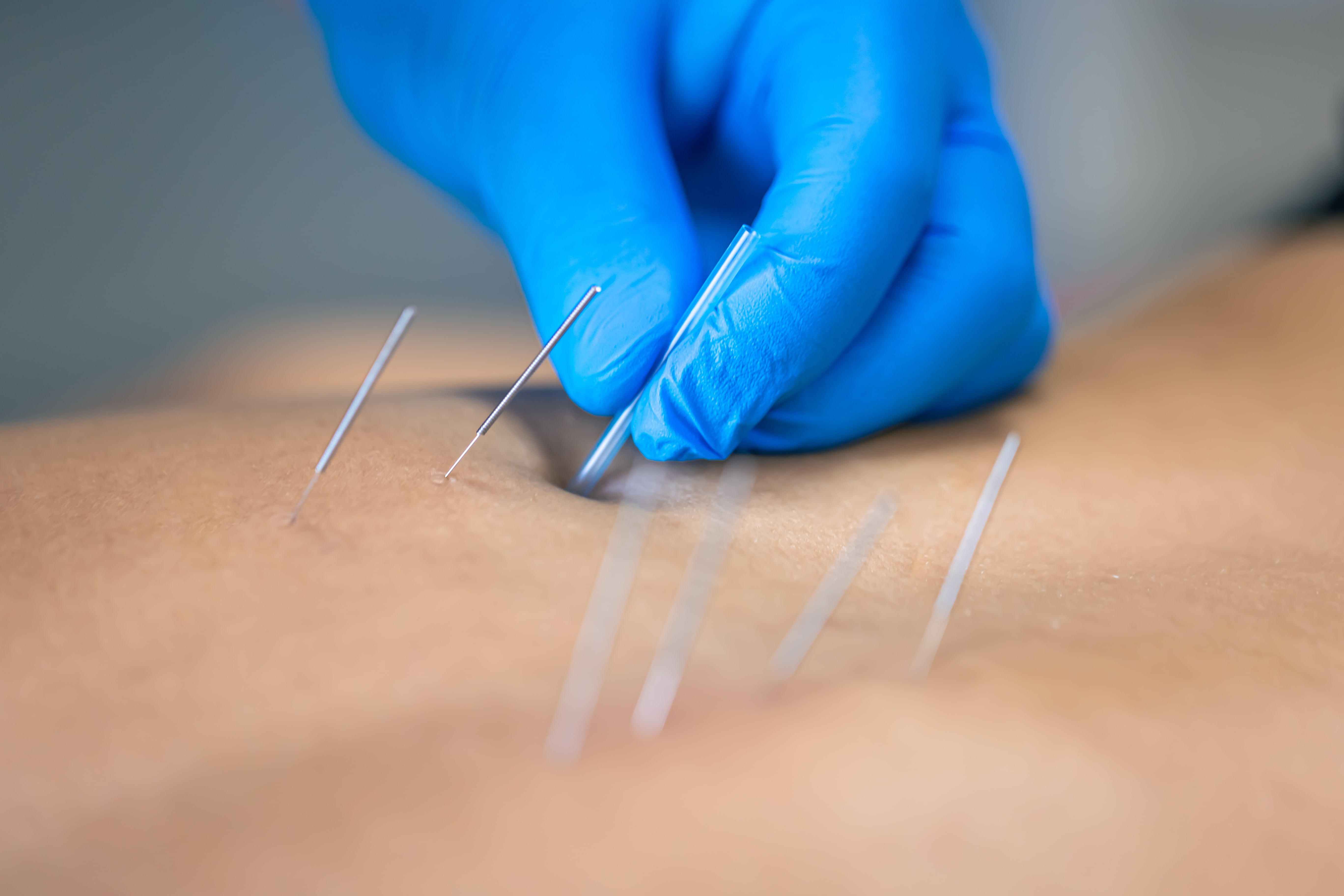 Fizik Tedavide Yeni Nesil Yaklaşım: Kuru İğneleme (Dry Needling) Nedir?